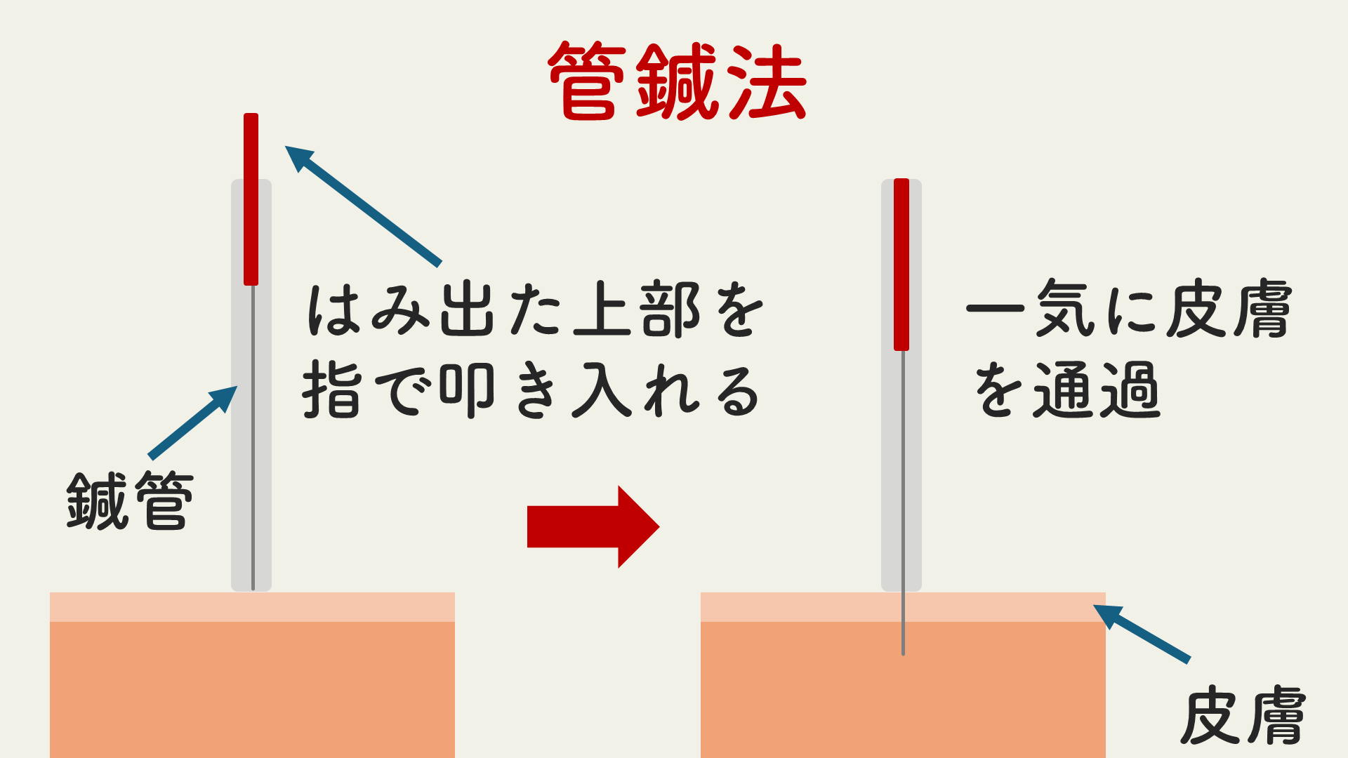管鍼法を用いると鍼が感覚受容器を一気に通過してしまう